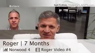 FUE Hair Transplant | Superior High-Yield Unit Extraction&reg; Result - 7 Months (Roger)