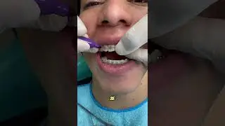 Cierre de espacios #dentista #dentist #dental #bracket #ortodoncia #brackets