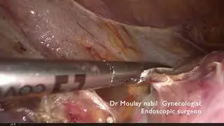 Supra cervical hysterectomy for 1400 grs uterus.Tips and triks