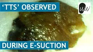 Temporary Threshold Shift (TTS) Observed during Endoscopic Ear Suction - #369