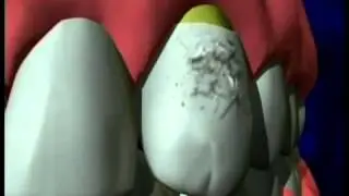Denver CO Dentist Sharing Dental Implant Video Animation for Missing Tooth