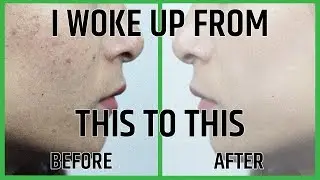 Aspirin for acne and scars - 5 Easy ways to use it!
