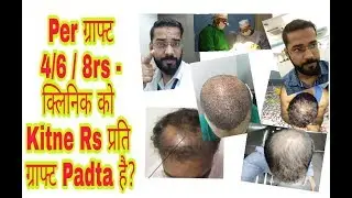 Real Cost of Hair Transplant Rs 4, 6, 8 Per Graft? || Rest is Profit & Commission in Hair Transplant