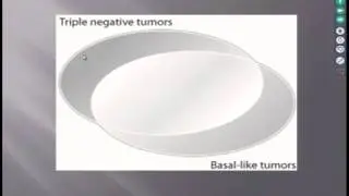 Progress in Breast Cancer 2002-2017: A Case-Based Presentation  12/13/17