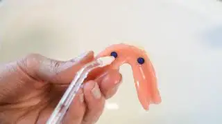 Orasana&reg; WaterJet Cleaning Implant over Dentures