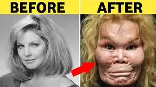 15 Celebrities Plastic Surgery Disaster | Beautiful to Ugly Transformation Of Celebs