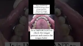 Combating Open Bite Relapse: Damon Braces with Tongue Tamers for Effective Tongue Habit Correction