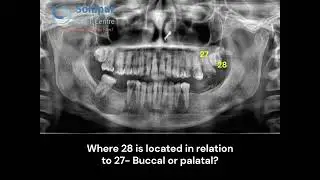 The Curious Case of Tooth #27 and the Hidden 28 | OPG | CBCT | THIRD MOLAR | HOW TO PREVENT CARIES