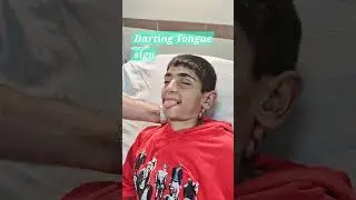 Signs of chorea - Rheumatic chorea - Neurological examination -Sydenham Chorea
