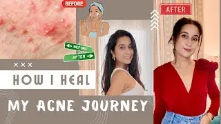 My Acne Journey | How I Cured My Severe Acne | Acne Treatment