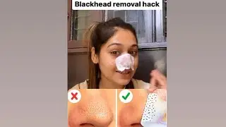 Blackhead removal hack #makeuphacks #hack #skincare