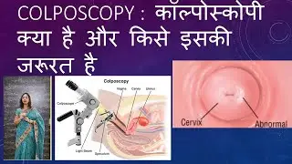 COLPOSCOPY कॉल्पोस्कोपी क्या है और किसे इसकी जरूरत है