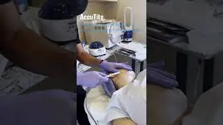 AccuTite, Minimally Invasive Body and Face Contouring #skintightening