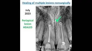 Healing of multiple periapical lesions non surgically.