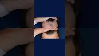 15 months post-transplant and looking amazing! 3,000 grafts using the NeoGraft FUE method