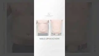 Male Liposuction results by Dr. Sanchez Navarro MD #MaleLiposuction #PlasticSurgery