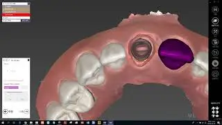 Case3 #3  design crown (extra multidie scan, mirroring)
