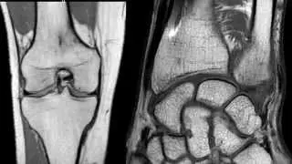 MRI: Imaging of the Joints