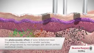 laser promotion