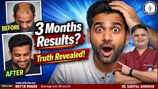 Hair Transplant FAQs Answered | Results Time, Safety & Side Effects | Dr. Santpal Sangwan