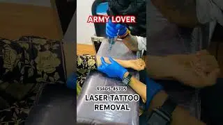 Army lover tattoo removal #army #indianarmy #armylover #love #motivation #edkv3 #tattoo #tattoo