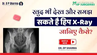 How To See A Hip Replacement X-Ray? Hip Pain Treatment In Delhi-NCR, Noida & Agra - Dr DP Sharma