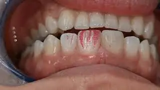 Anterior Composite Characterization