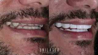 porcelain veneers | Carillas en porcelana