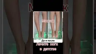 варусная деформация колен.  В детстве исправляется ортопедическим массажем #массаж #дети #топ #вирус
