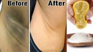 Best for  Dark Under Arms insistent  | Dark Neck | Dark Knee | Pigmentation | #ummilife #viral