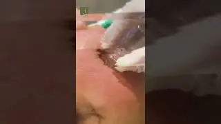 Baby Botox at The Krisalys Aesthetics
