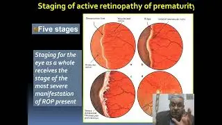 4 -2025 retinal dystrophies AMD TUMORS ROP