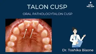 Talon cusp | Oral Pathology | NEET MDS