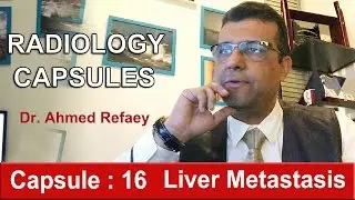 Capsule : 16 - Liver Metastasis