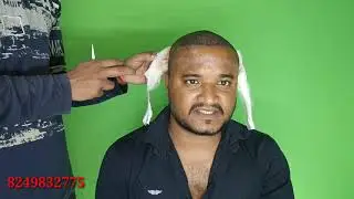 Bandage Remove after Hair Transplant| #hairtransplant #hairfall