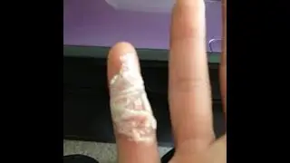 How To Get A Splinter Out - An Easy Painless Way To Get A Splinter Out