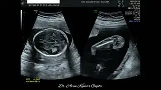 Anomaly Scan : 18 Weeks 2 Days Gestation