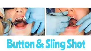 #9 BRACES VISIT PH2😬Bonding Button & Sling Shotting