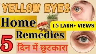 आखों के पीले पन से छुटकारा पाए | How to get rid of yellow Eyes.