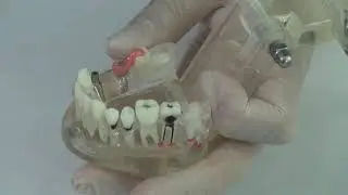 Implant (abutment) verification Jig