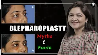 Dr. Shilpi Bhadani Shares Common Myths about Blepharoplasty (Upper & Lower Eyelids Surgery)