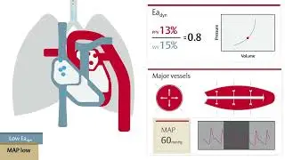 EaDyn with High Fluid Bolus