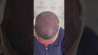 Hair Transplant Transformation: 5000 Grafts