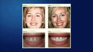 Long Beach on Worn Teeth
