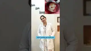 Can Cavities Go Away? Dr Swetha | KPHB & Manikonda | Best Dental Hospital in Hyderabad