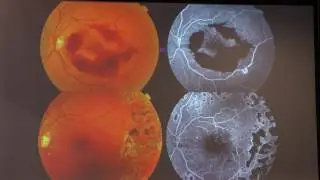 Лазерная коагуляция сетчатки при диабетической ретинопатии