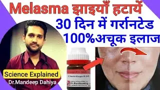 Melasma treatment | melasma homeopathic treatment | hyperpigmentation homeopathic medicine | video