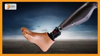Disabled Molol girl receives artificial limb donated by St. Luke’s hospital