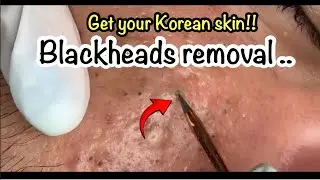 Overnight Korean Glass Skin Transformation Ritual Blackheads on nose new this weekblackheads removal