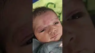 Red patches on baby's face | Birth mark on baby's face #baby